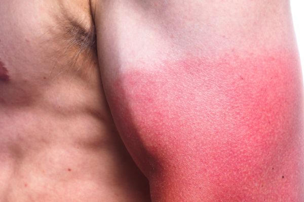 UV Skin Protection